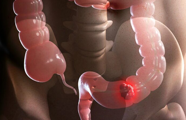 El cáncer colorrectal se protege de la inmunoterapia con un doble escudo