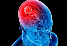 La presión que provocan los tumores cerebrales puede causar un daño irreversible en las neuronas