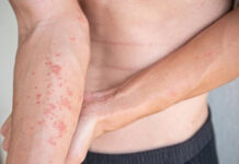 Así influyen las emociones en la piel y empeoran la dermatitis