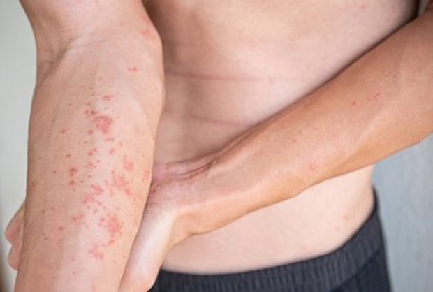 Así influyen las emociones en la piel y empeoran la dermatitis
