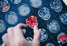 Descubren cómo las células tumorales alteran el cerebro y logran diseminar el cáncer