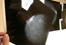 Desvelan por qué el riesgo de cáncer de mama aumenta tras la menopausia