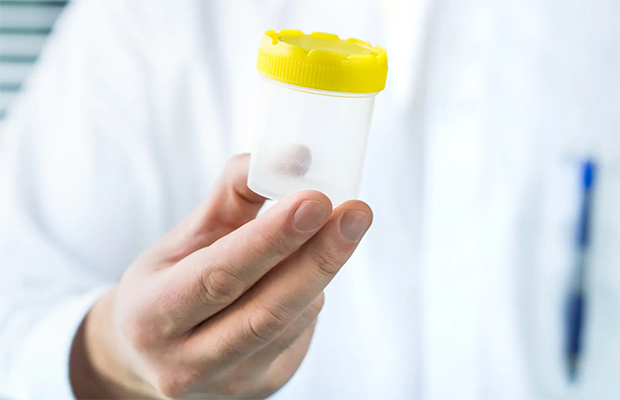 Detectan el primer caso de transmisión de una enfermedad rara mediante donante de esperma