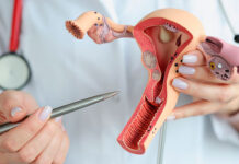 Identifican un marcador que predice la recaída en el cáncer de endometrio más común