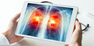 Inflamación y plasticidad celular explicarían la resistencia del cáncer de pulmón de células pequeñas