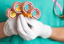 La paradoja del colesterol: Bajar mucho sus niveles es tan riesgoso como tenerlo alto