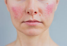 Rosácea: ¿Por qué advierten que es una enfermedad inflamatoria que necesita un tratamiento integral?
