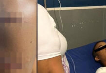 Adolescente casi pierde un brazo al ser embestido por una lancha en Falcón