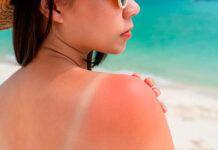 ¿Cómo aclarar tu piel después de ir a la playa?