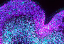 Describen cómo el síndrome de Down altera el desarrollo del cerebro antes de nacer