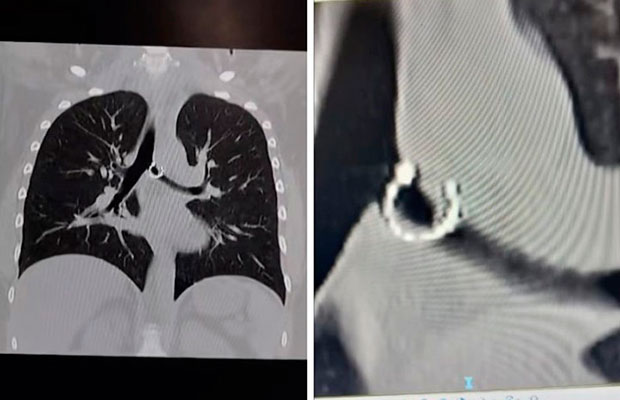 Empezó-a-toser-y-descubrió