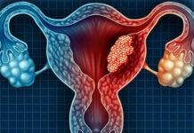 Un análisis genético a gran escala identifica regiones asociadas a la endometriosis