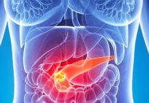 Un nuevo fármaco duplica la supervivencia a un año en un ensayo de cáncer de páncreas