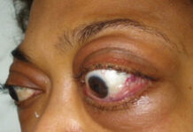 Esta es la enfermedad tiroidea que afecta la salud de los ojos
