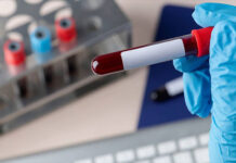 Desarrollan un test para detectar el cáncer de páncreas mediante una muestra de sangre