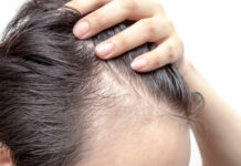 ¿Las entradas en el cabello son señal de alopecia?