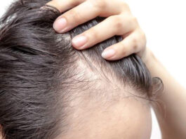 ¿Las entradas en el cabello son señal de alopecia?