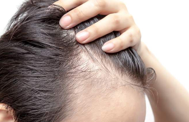 Las entradas en el cabello son señal de alopecia