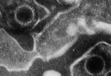 Un estudio arroja luz sobre cómo el virus de Epstein-Barr provocaría esclerosis múltiple