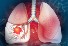 Encuentran tratamiento que puede reducir el riesgo de cáncer pulmonar