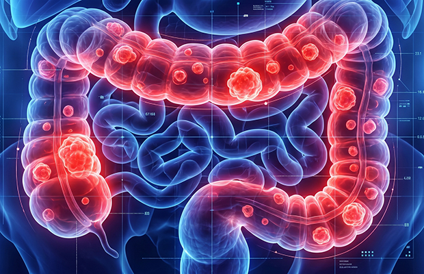 Las pruebas de detección precoz de cáncer colorrectal podrían reducir cerca de la mitad de las muertes