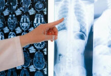 Terapia dirigida reduce 94 % riesgo de progresión intracraneal en tipo de cáncer de pulmón