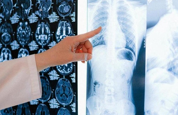 Terapia dirigida reduce 94 % riesgo de progresión intracraneal en tipo de cáncer de pulmón